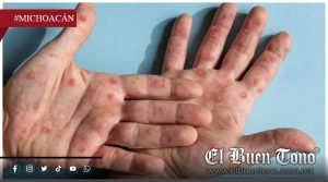 México registra brote de sarampión; confirman primera mverte de 2026