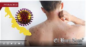 Veracruz reporta 30 casos confirmados de sarampión en 2026