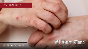 Veracruz registra 44 casos de sarampión en 2026 bajo vigilancia epidemiológica