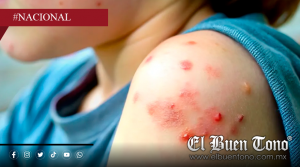 Bajan 30% los casos activos de sarampión en México; Autoridades piden no bajar la guardia